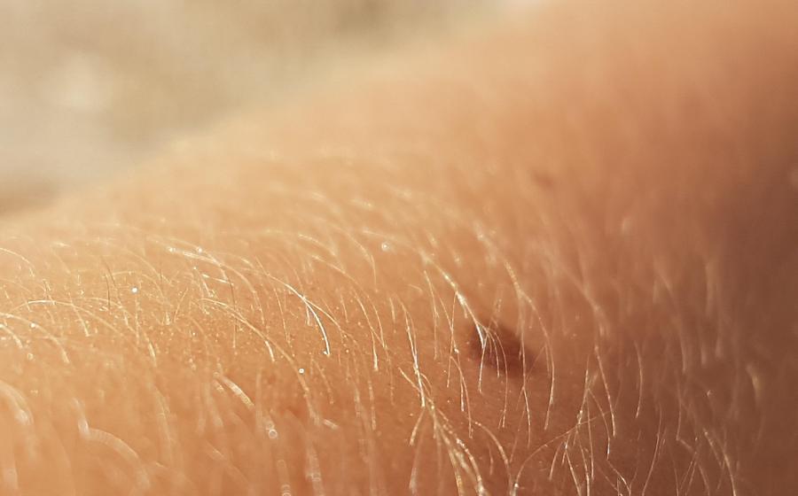 Piha na kůži, autor obrázku Fermi, zdroj Pixabay.com